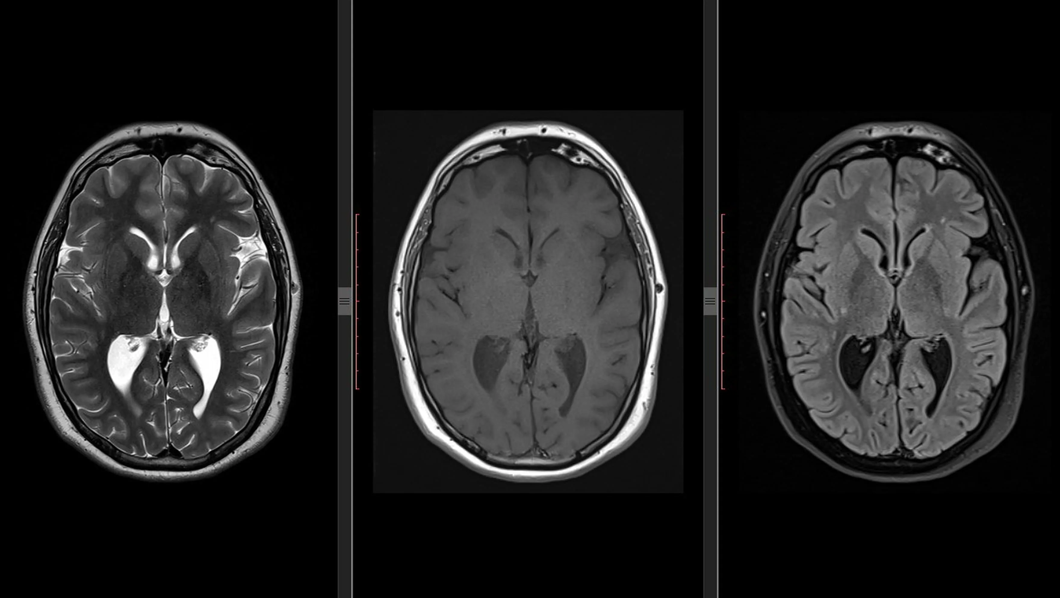 Magnetic Resonance Images (MRI) Detection and Registration