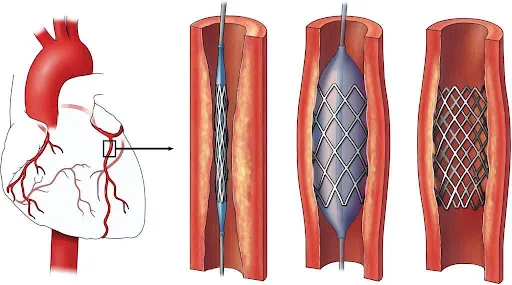 Development and characterization of a novel biomaterial based cardiac stent for atherosclerosis treatment 