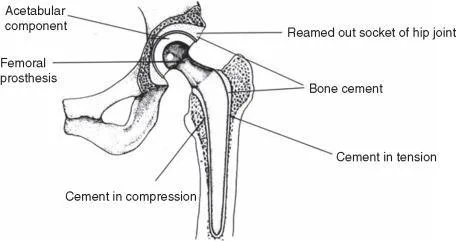 Designing an industrial product development project for bone cement preparation in the orthopedic applications